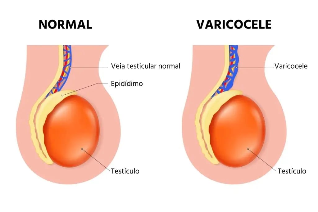 Tratamento de varicocele